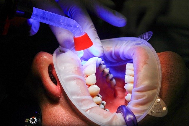 Conceitos e diferenças entre periodontite e gengivite