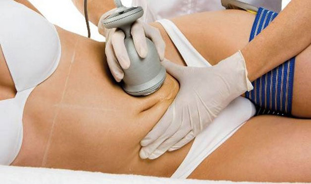 Lipoaspiração a laser funciona?
