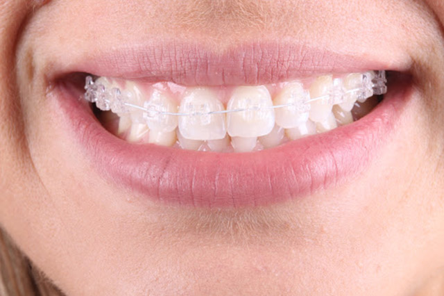 Alinhamento dos dentes é possível